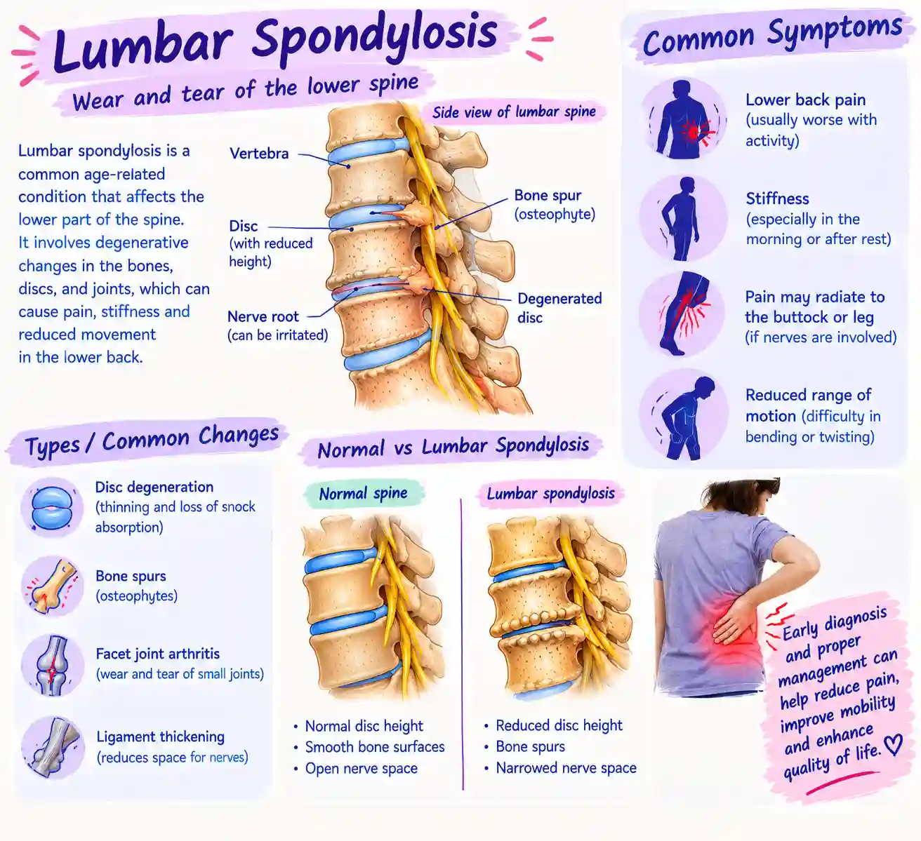Lumbar Spondylosis