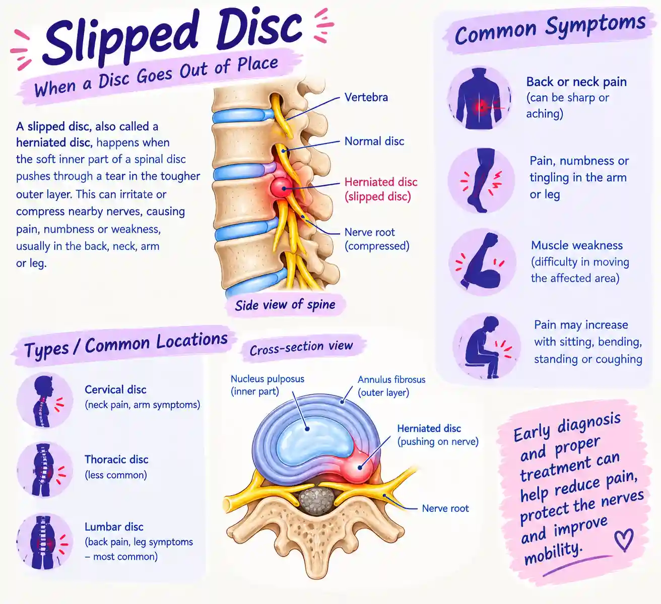 Slipped Disc